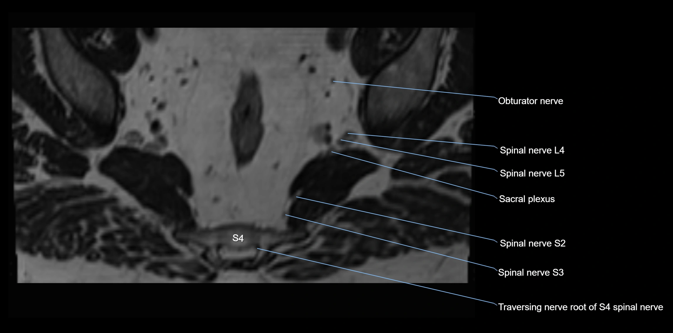 MR lumbosacral plexus axial cross sectional anatomy 3T  radiology  image-img-1008001-00099.webp
